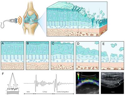 Research progress of ultrasound in accurate evaluation of cartilage injury in osteoarthritis